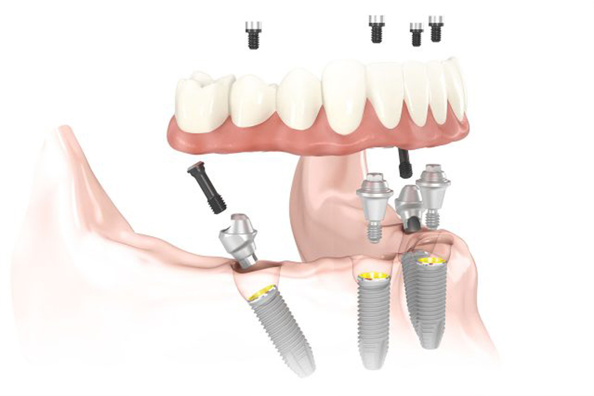 Dental Implants in Mexico Tijuana