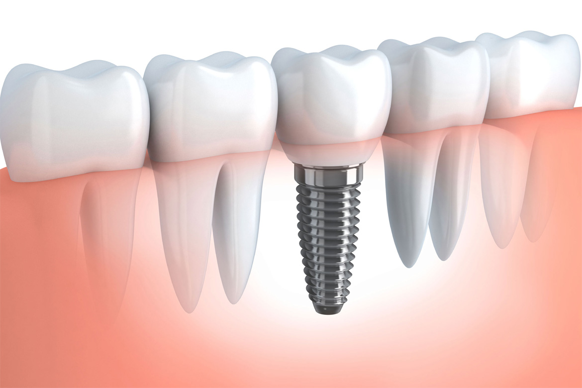 Dental Implants in Mexico Tijuana